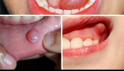 Hidden Dangers in Your Mouth: Early Signs of Oral Cancer You Should Never Ignore