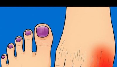 Signs of Kidney Disease in the Feet