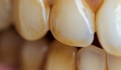 Dentists Won’t Tell You This: Natural Ways to Remove Tartar and Whiten Teeth at Home