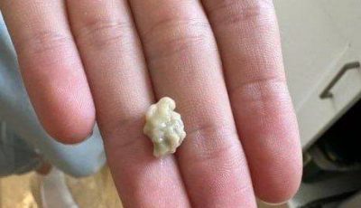 Here’s What You Need to Know About Tonsil Stones