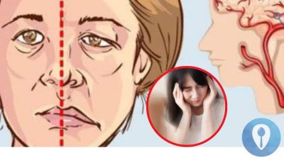 Stroke symptoms can appear very early