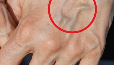 Visible Veins What They Mean and Why You Might See Them