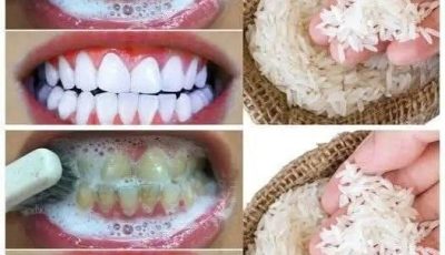 RAPID TEETH WHITENING in 1 Minute!