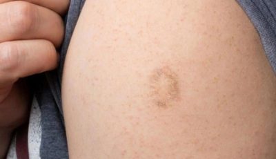 Here’s The Truth Behind This Scar On People’s Upper Left Arm