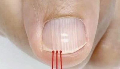 If you have these lines on your nails after 40, it is a clear sign that..