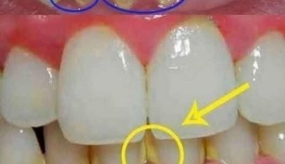 Remove dental plaque in 5 minutes naturally, without going to the dentist.