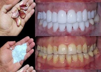 How to whiten your teeth in 2 minutes?