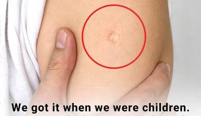 The Truth Behind the Mysterious Round Scar on the Upper Arm