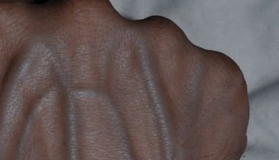When to Worry About Veins That Appear Out of Nowhere