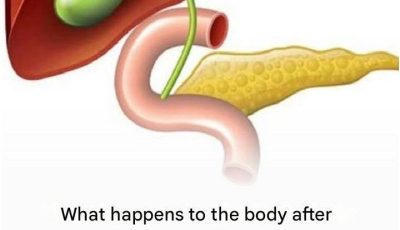 What Happens to the Body After Gallbladder Removal? 3 Diseases That May Follow – Avoid Surgery If Possible