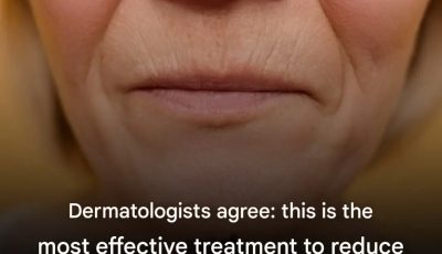 Dermatologists agree: this is the most effective treatment to reduce wrinkles around the mouth.