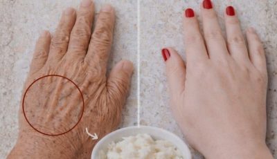 Vaseline and Lemon: An Inexpensive and Effective Skincare Remedy