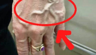 When to Worry About Veins That Appear Out of Nowhere