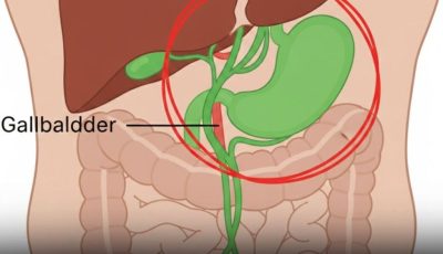 After Gallbladder Removal: 3 Conditions You Could Develop — Why You Should Avoid the Surgery When Possible
