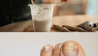 10 Natural Remedies to Use If You Have Damaged Toenails
