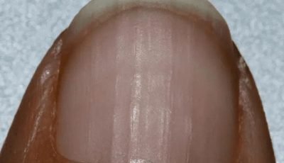 If you have grooves on your nails, it says something about your health.