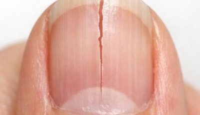Why Fingernails Split Vertically and How to Care for Them