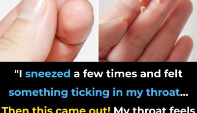 Here’s What You Need to Know About Tonsil Stones