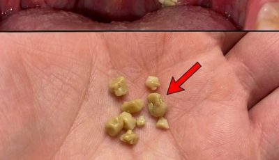 Causes of White or Yellow Balls on the Tonsils – What They Are & How to Treat Them