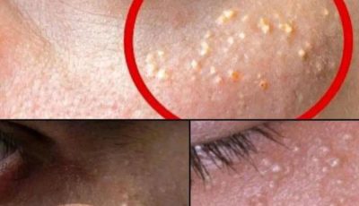 If you have these tiny, white spots on your face, do not try to remove them. Here’s what you should do instead: