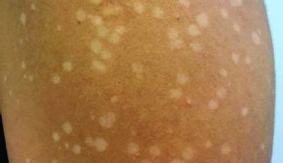 Asymptomatic Hypopigmented Macules and Patches — What They Are and When to See a Doctor