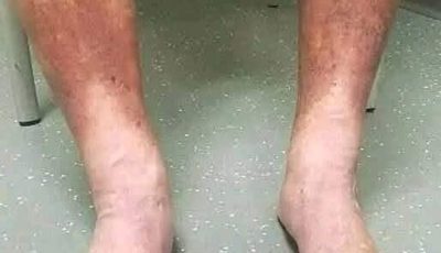 Clear Signs of ALS (Amyotrophic Lateral Sclerosis)