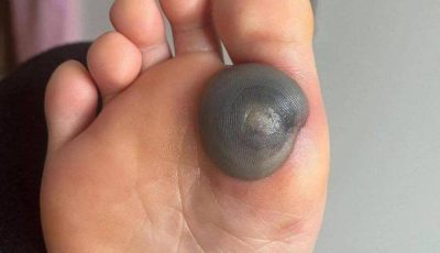My Daughter Woke Up With a Huge Spot on Her Foot — Could It Be a Blood Blister?