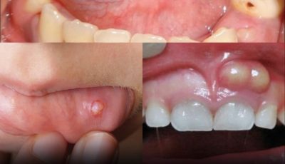 Hidden Dangers in Your Mouth: Early Signs of Oral Cancer You Must Not Ignore
