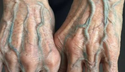 The Truth About Visible Veins in Your Hands: When It’s Normal and When It’s a Signal