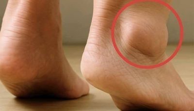 Swollen Legs and Feet: Causes, Symptoms & Natural Relief Methods