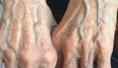 When Visible Veins Are More Than a Cosmetic Issue