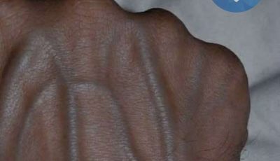 If Your Veins Are Visible in Your Hands, It’s a Signal of… (Here’s What It Really Means)
