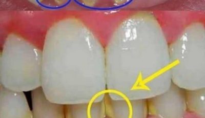 Remove Plaque in 5 Minutes Naturally, Without Going to the Dentist