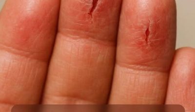 My Fingertips Keep Splitting Open in the Cold — What Can I Do Now? (Doctor-Approved Home Care)