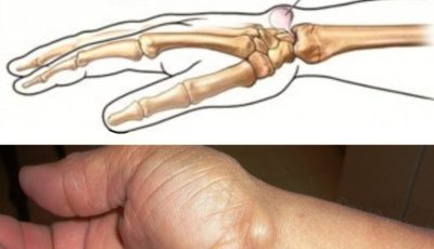 Noticing a Lump on Your Hand? Here’s What You Need to Know — When to Worry (and When Not To)