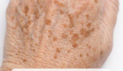 My Grandmother Taught Me This Simple Method to Fade Dark Spots on Hands. Here’s How It Works