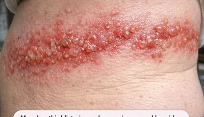 Mom has this blistering rash wrapping around her side. She says the burning pain is unbearable. ER wait is 8 hours! What can we do?