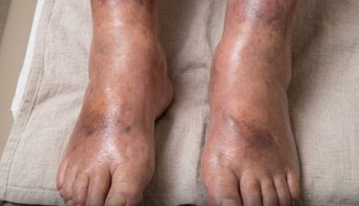 The Silent Signal: What Your Legs May Reveal About Pancreatic Health
