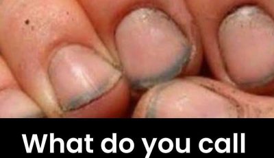 What do you call a person who has nails like that?