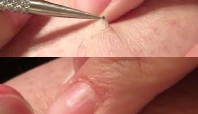 A man discovered a black spot on his leg and began to peel it off. What he removed left millions speechless.