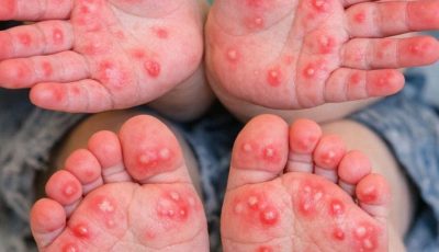 Toddler Has Red Spots on Palms & Soles + Won’t Walk? What to Do When the Doctor’s Booked