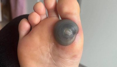 My daughter woke up with this huge spot on her foot I don’t know what it could be. She’s been in pain and can’t move her foot what is this.. Explain this