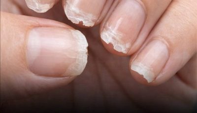 Weak or Brittle Nails: What Your Body Is Trying to Tell You