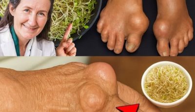 Your Natural Ally Against Kidney Stones and Gout