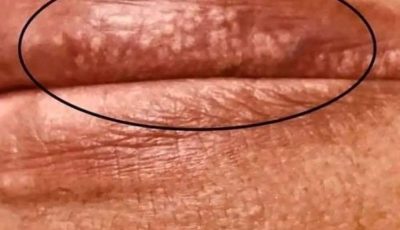 Pimples or bumps on the lips or intimate (genital) area can happen for several