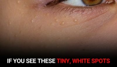 If You Notice Tiny White Bumps on Your Face, Here’s When to Leave Them Alone