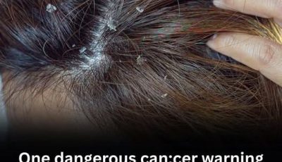  What Looks Like Dandruff May Be Something More Serious