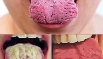 The shock hits you when you look in the mirror: your tongue is covered with a strange white film. It feels abnormal to the touch.