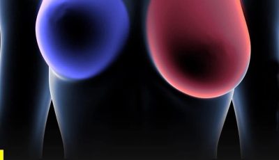 Breast cancer: 4 early signs every woman should know.