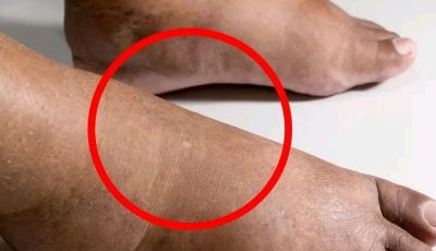 A Doctor Breaks Down 10 Common Causes of Swelling in the Feet and Ankles 